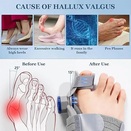 FeetifFix - Bunion Corrector